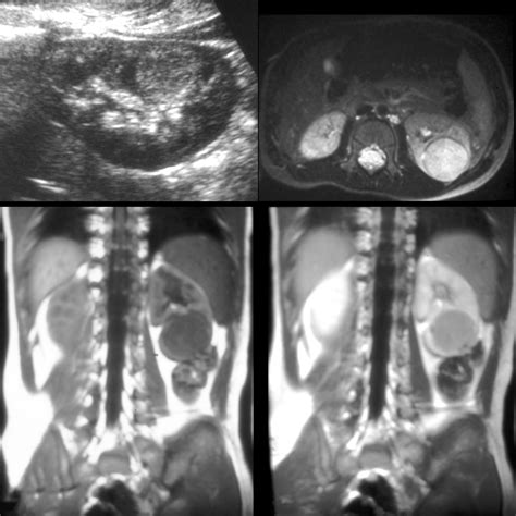 Wilms Tumor Pediatric Radiology Reference Article Pediatric Imaging