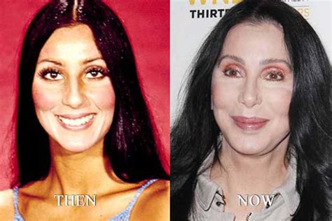 Cher Plastic Surgery Breasts Augmentation Nose Job Facelift