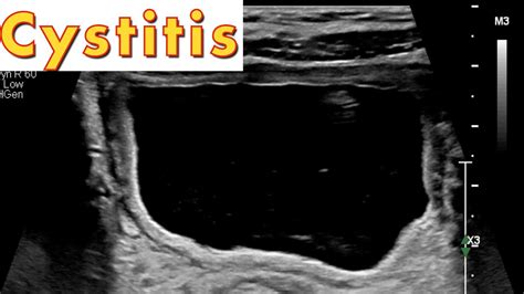 Cystitis On Ultrasound Youtube