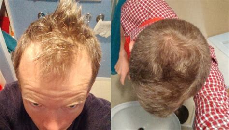 can scalp massage really regrow hair top hair loss treatments