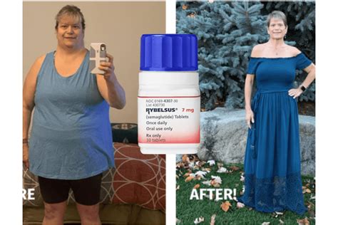 Rybelsus Weight Loss Breakthrough In New York Usa Spring 2024 New