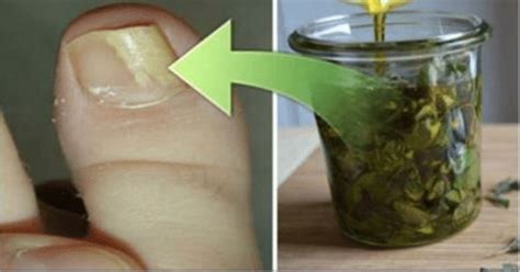Simple And Easy To Make Remedy That Will Remove The Fungus From Your