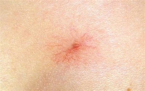 Spider Angioma Symptoms Causes Pictures Treatment 2018 Updated