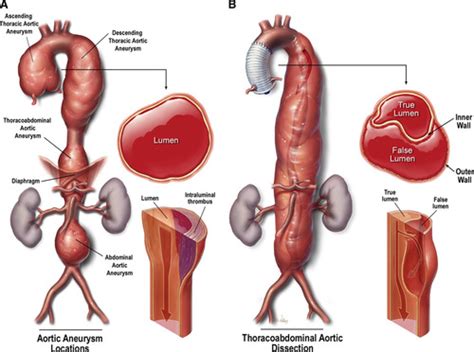 Aortic Aneurysms And Dissections Series Arteriosclerosis Thrombosis