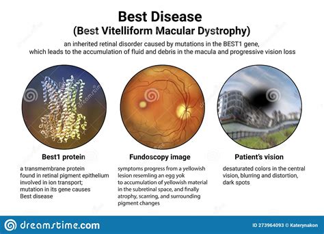 Best Vitelliform Macular Dystrophy 3d Illustration Stock Illustration