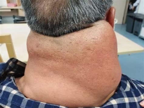 Mans Addiction To Spirits Leaves Him With Severely Swollen Neck