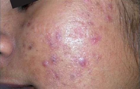 What Is Butt Acne Treatment Options And Causes Of Butt Acne