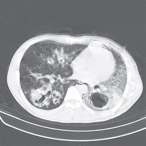 Chest Ct Scan Showing Large Opacities On The Left Upper Lung In Case 1
