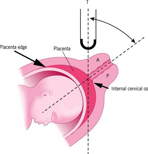 Diagram Demonstrating The Technique For Transvaginal Sonography Of My