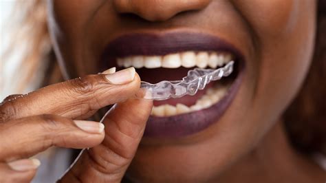 How Expensive Is Invisalign Find Out What To Expect In Coral Springs