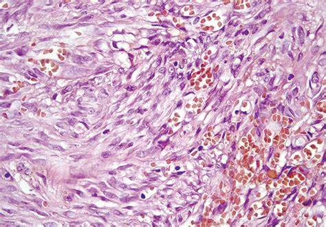 К вопросу о саркоме Капоши uMEDp Картинка - К вопросу о саркоме Капоши uMEDp