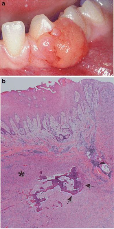Peripheral Ossifying Fibroma A Left Lower Jaw Nodular Lesion Between