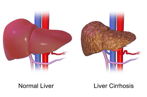 Cirrhosis Permanent Scarring Of Liver Agency Wire