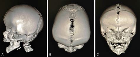 Nonsyndromic Bicoronal Craniosynostosis Neupsy Key