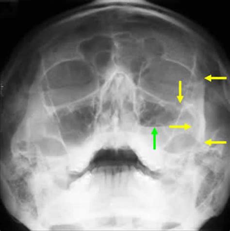 Zygomatic Fracture X Ray