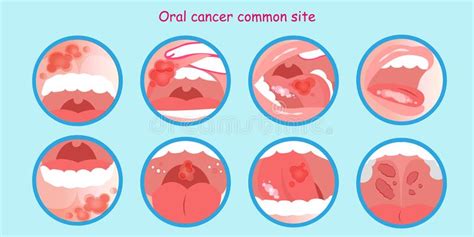 Oral Cancer Everything You Should Know Smile 360 Dental Clinic