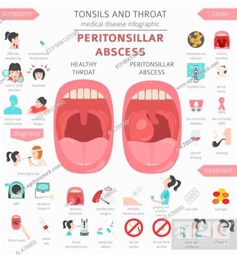 Tonsils And Throat Diseases Peritonsillar Abscess Symptoms Treatment Icon Set Stock Vector