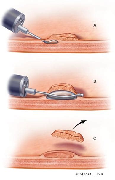 Endoscopic Mucosal Resection For Management Of Large Colorectal Polyps