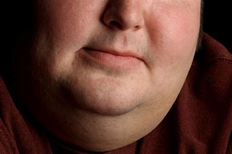 Fda Approves Drug To Combat Fat Underneath The Chin