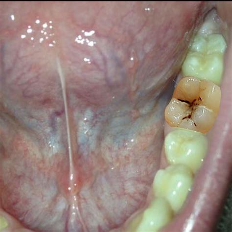 Karies ist eine der häufigsten zahnkrankheiten. Schon wieder Karies