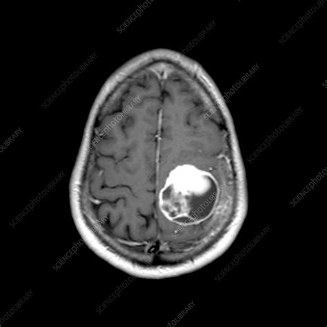 Mri Of Cystic Meningioma Stock Image C0047481 Science Photo Library