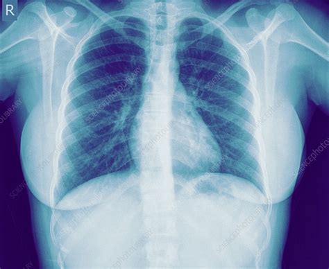 These lung fields are seen on either side of the heart and the vertebrae located in the. Normal healthy Chest x-ray - Stock Image - C019/7307 ...