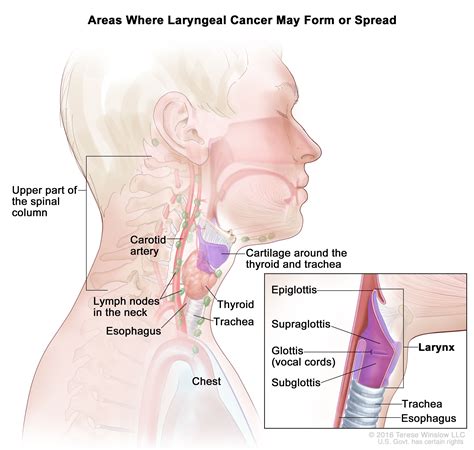 Learn everything about head and neck anatomy using this topic page. Laryngeal Cancer Treatment (Adult) (PDQ®)-Patient Version ...