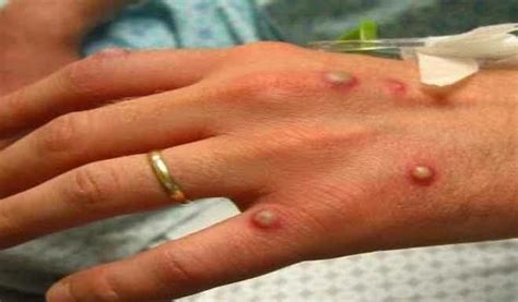 Monkeypox virus, ictv accepted 1). Rare monkeypox virus is reappearing - here's what you need ...