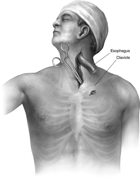 Esophageal Diversion Operative Techniques In Thoracic And