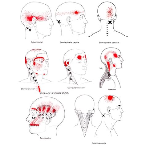 Headaches And Neck Pain Or Cervicogenic Headache