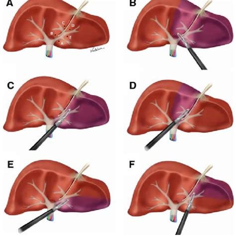 Diagrams Of Trocar Placement For Laparoscopic Left Liver Resection