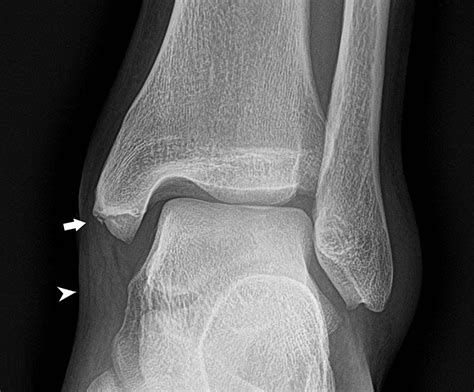 Cureus Radiographic Imaging Of Parachuting Related Ankle Fractures