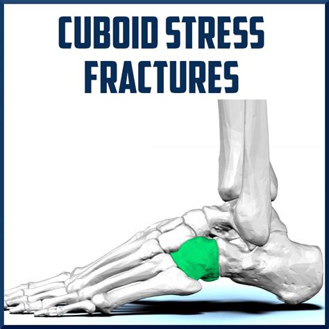 Cuboid Stress Fractures Sports Medicine Review