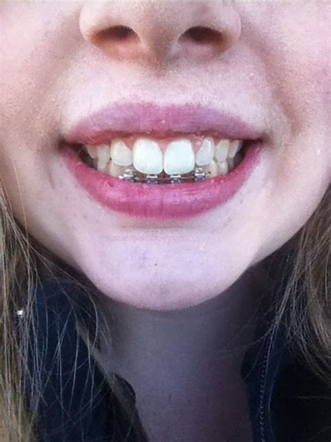 How long to wear retainers? Katie's Double Jaw Surgery: Day 261 - BRACES OFF