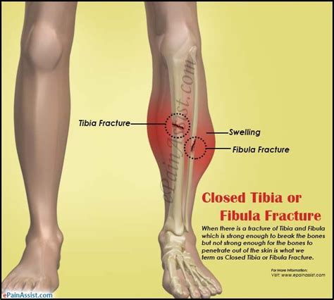 In rare cases, external fixation or orif is more appropriate radiographs of the tibia and fibula are provide in figures a and b. Closed Tibia or Fibula Fracture | Treatment recovery ...