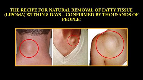 The Recipe For Natural Removal Of Fatty Tissue Lipoma Within 8 Days