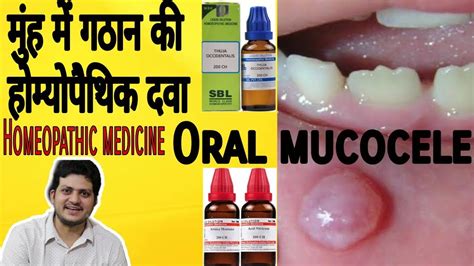 Mucocele Homeopathic Medicine For Oral Mucocele Youtube