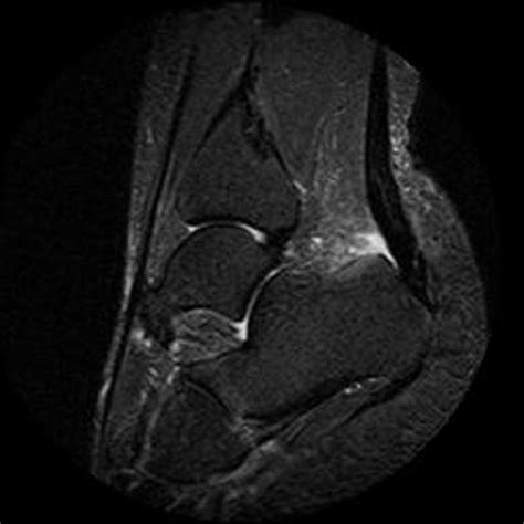 Insertional achilles tendinitis and haglund's deformity. loading stack 0 images remaining