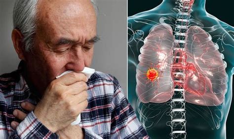 Lung Cancer Symptoms Signs Include A New Dry Cough And When To See