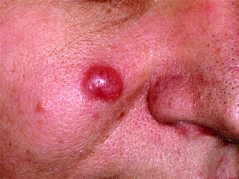 Information on the course and outcome of borrelial lymphocytoma (bl) is limited. Borrelia lymfocytoom