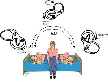 This mnt knowledge center article explains how it is performed and how it helps. BPPV -- Semont maneuver