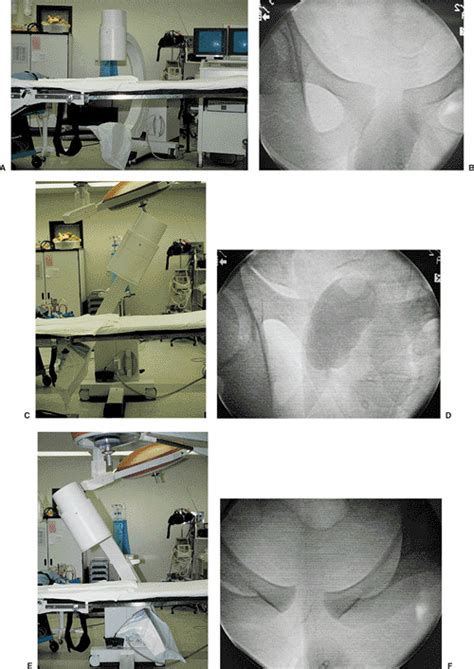 Diastasis Of The Symphysis Pubis Open Reduction Internal Fixation