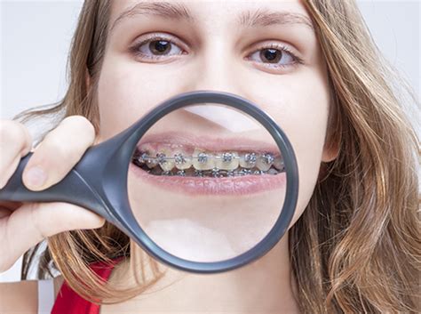 Tips For Caring For Your Braces At School
