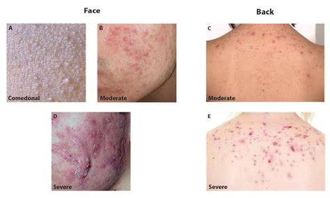 The New Canadian Guideline For Acne Treatment