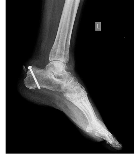 Avulsion Fracture Avulsion Fractures Of The Ankle Physiopedia
