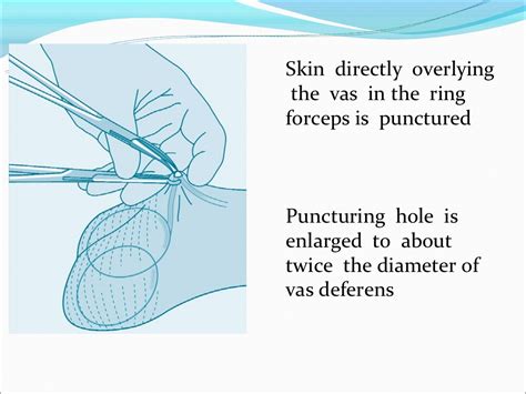 Vasectomy represents a surgical procedure for male sterilization. No- scalpel vasectomy