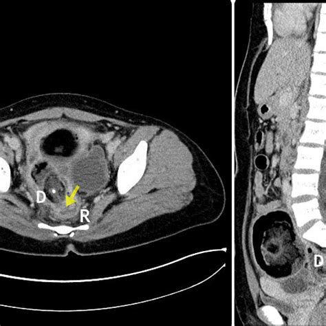A Fistula Between The Dermoid Cyst And The Rectum Arrow A