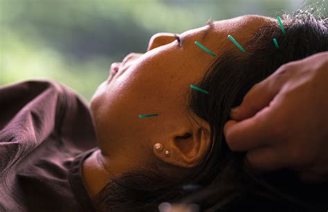 manual acupuncture versus sham acupuncture and usual care for prophylaxis of episodic migraine