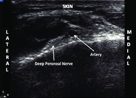 Ultrasound Image Of The Deep Peroneal Nerve In The Ankle The Dorsalis
