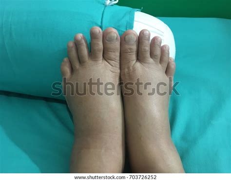 Two Swollen Legs Pregnant Woman Stock Photo 703726252 Shutterstock